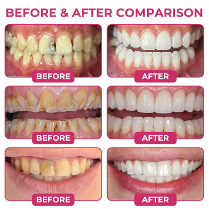 🇺🇸 Official Store | ✨ Trilumia® DenPerm🦷 Cavity-Repair Natural Enamel Filling Gel