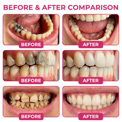 🇺🇸 Official Store | ✨ Trilumia® DenPerm🦷 Cavity-Repair Natural Enamel Filling Gel